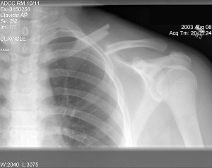 clavicle-fracture-300x238