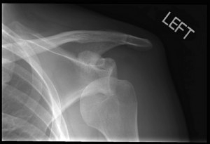dislocated-shoulder-300x205